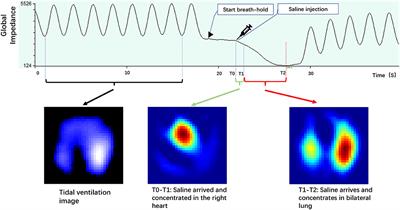 Lung Perfusion Assessment by Bedside Electrical Impedance Tomography in Critically Ill Patients